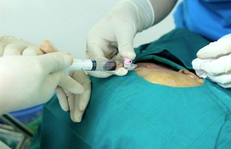 Bác sĩ có thể dẫn lưu dịch tụ