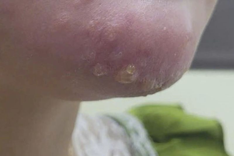 Tiêm filler cằm sai kỹ thuật gây nhiễm trùng
