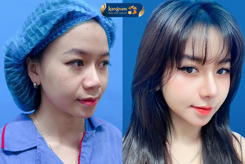 Thu nhỏ đầu mũi kết hợp nâng mũi