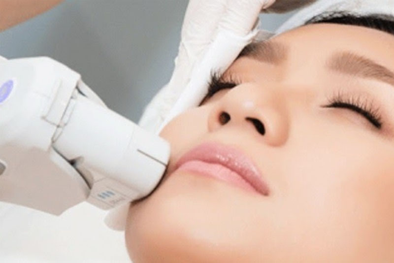 Triệt lông mặt bằng tia laser mang đến hiệu quả cao