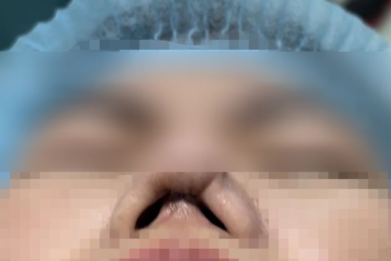 Người đã nâng mũi nhiều lần