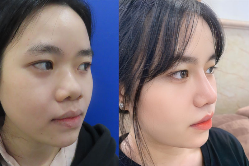 Khắc phục toàn diện dáng mũi thấp