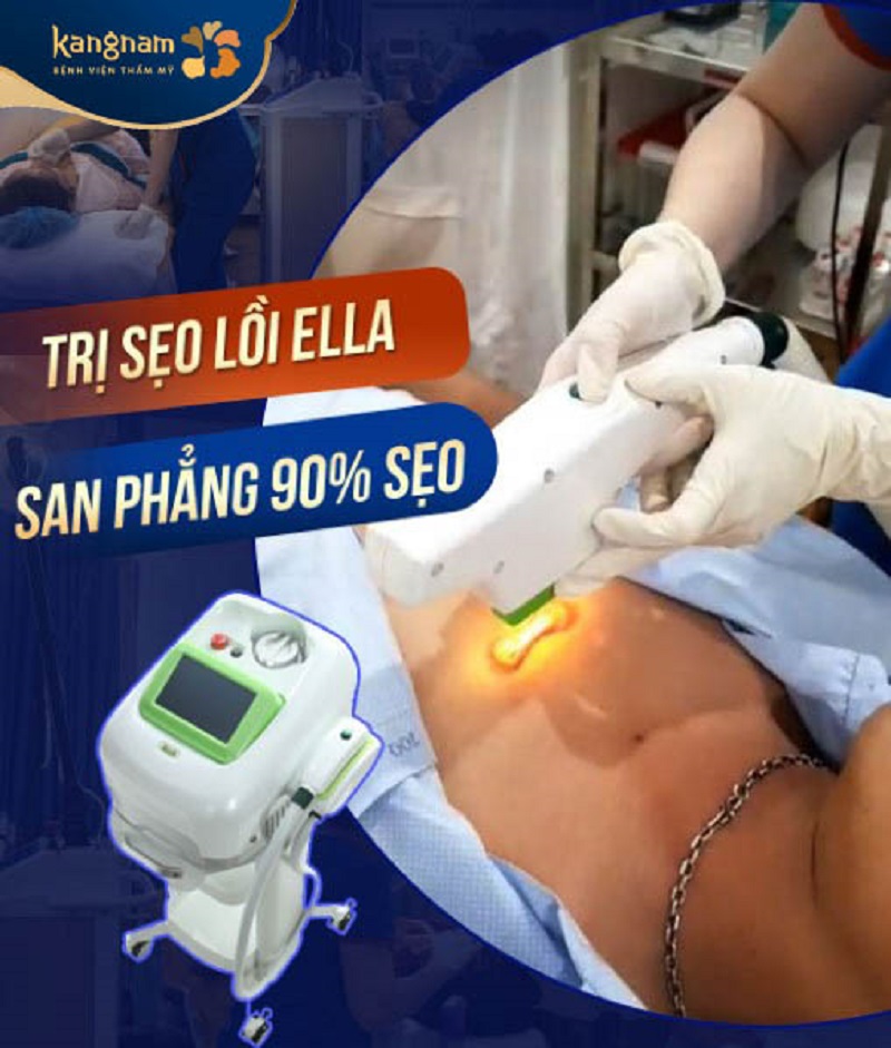 Kangnam đang ứng dụng công nghệ trị sẹo lồi ELLA