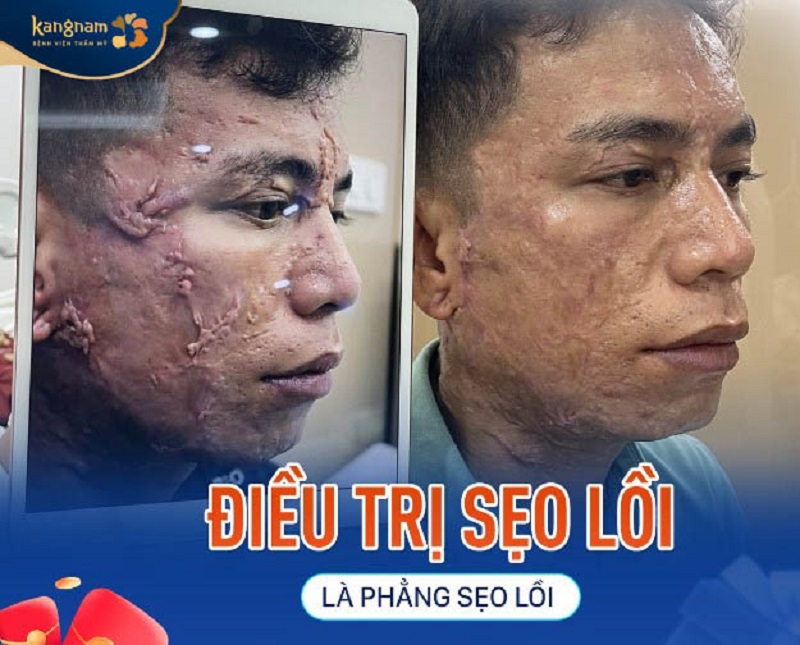 Sẹo lồi được là phẳng, mang lại hiệu quả rõ rệt