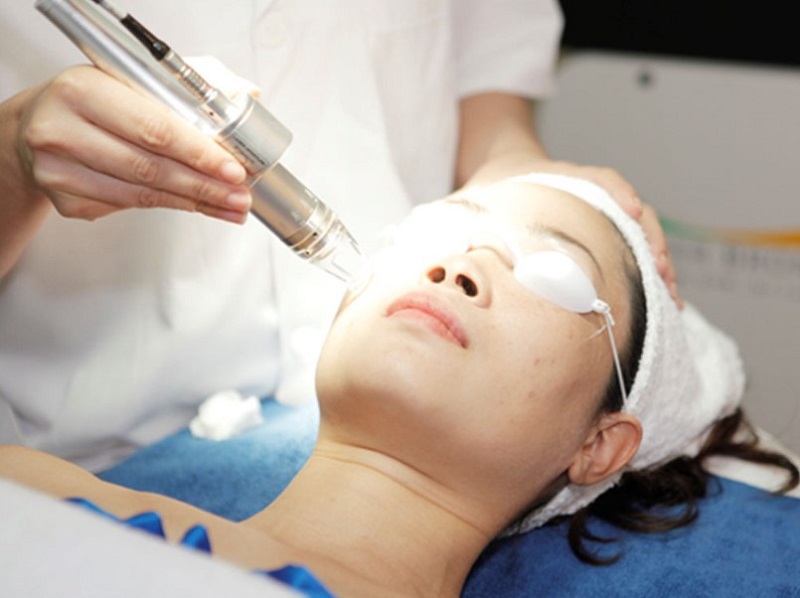 Laser Fractional CO2 sử dụng bước sóng phù hợp để làm đầy các vết sẹo