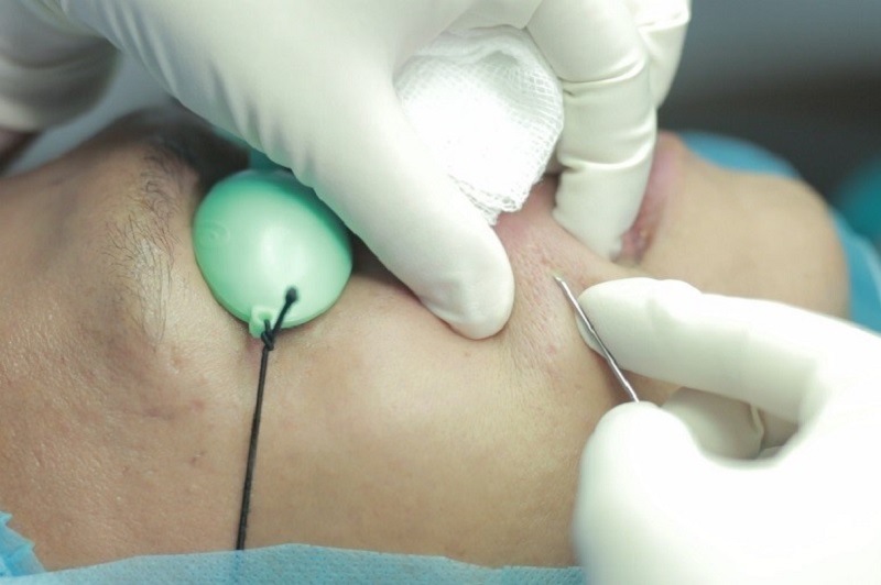 Bóc tách đáy sẹo rỗ có tác dụng loại bỏ chân sẹo lâu năm
