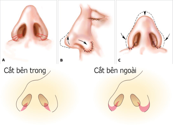 Mô phỏng kỹ thuật thu gọn cánh mũi