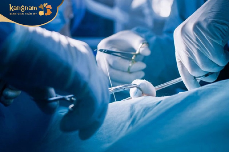 Sau khi thực hiện vùng nách khô thoáng, sạch sẽ, không để lại sẹo