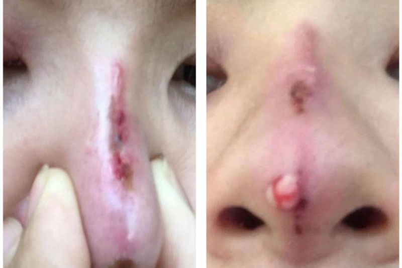 Biến chứng do nâng mũi chỉ sai kỹ thuật