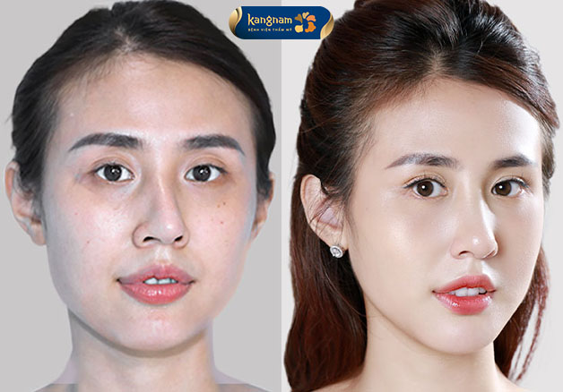 Khách hàng sửa lại dáng mũi lệch, sở hữu sống mũi cân đối