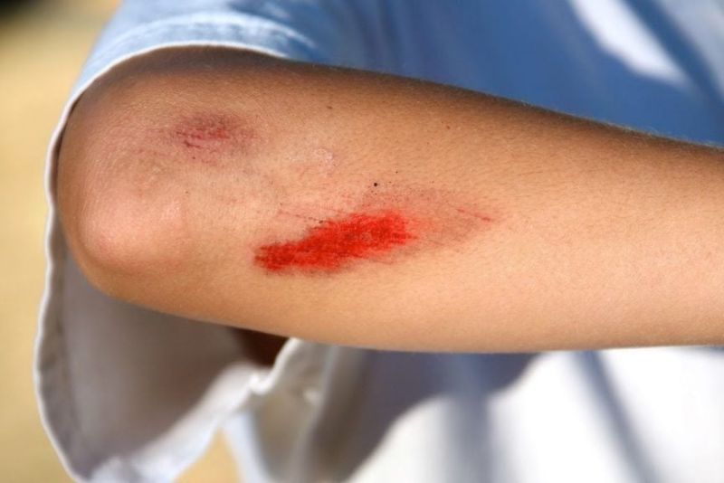 Vùng da có vết thương hở, trầy xước không nên triệt lông