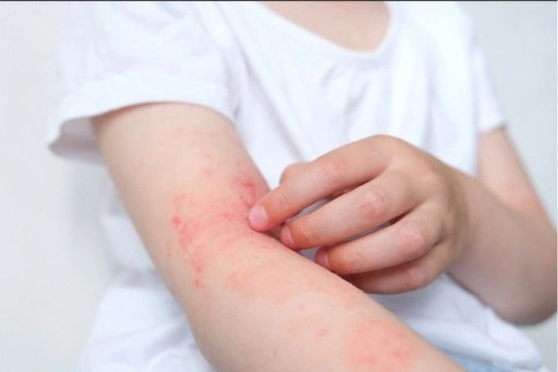 Triệt lông vĩnh viễn bằng laser có thể gây kích ứng nếu thực hiện sai kỹ thuật