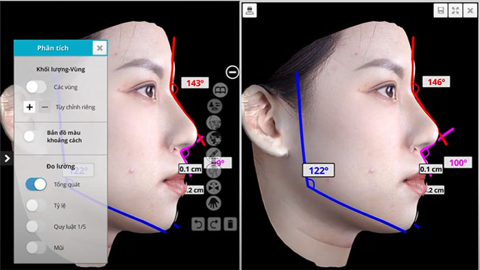 Mô phỏng trước khi nâng mũi cấu trúc bằng 3D AI Face Design
