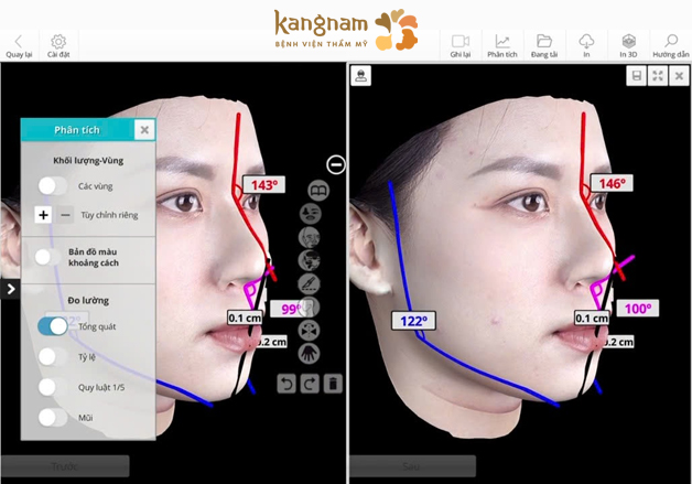 Cận cảnh mô phỏng dáng mũi bằng công nghệ AI Face Design 3D