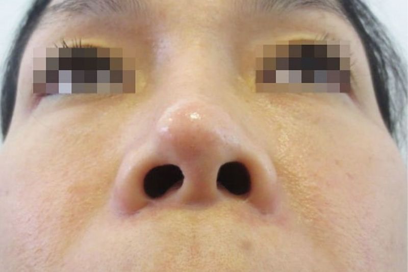 Đầu mũi bóng đỏ – dấu hiệu cảnh báo sớm tình trạng lòi sụn.