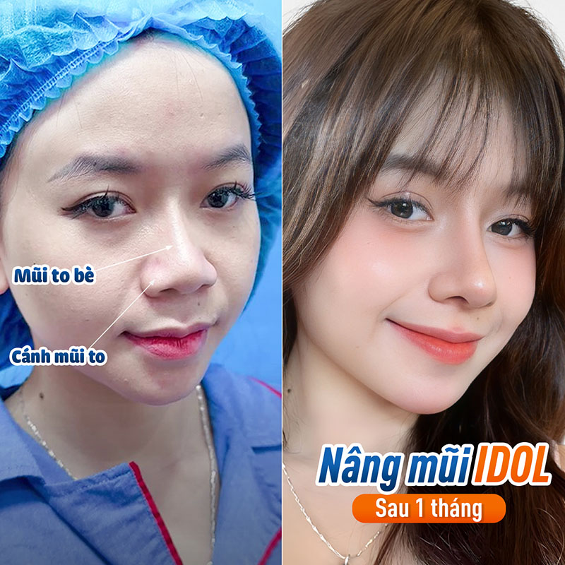 Khách hàng nâng mũi Idol nhanh vào form