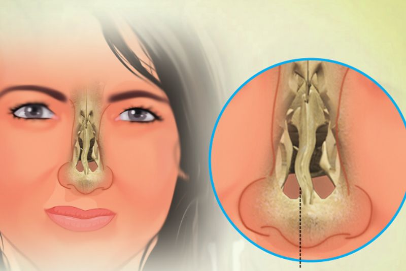 Dùng kẹp sai cách có thể gây lệch mũi