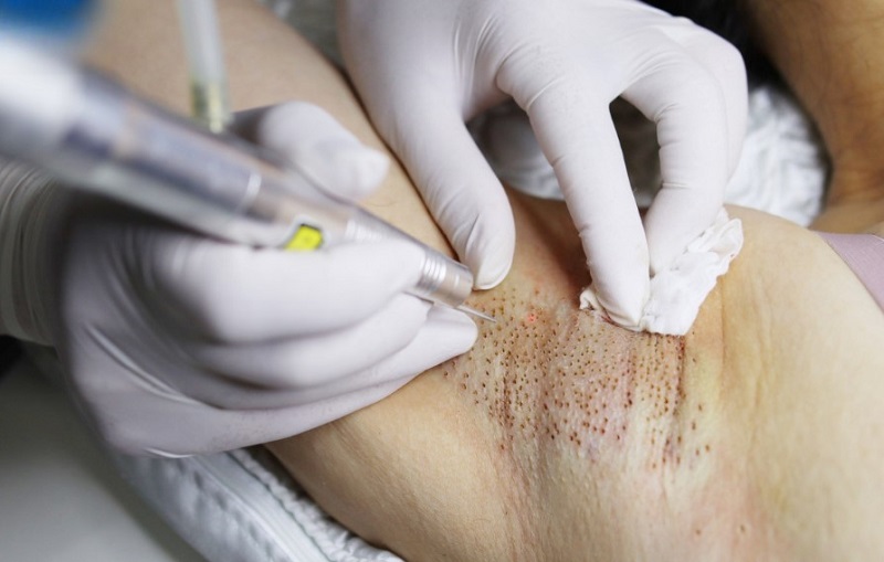 Phương pháp trị hôi nách bằng laser cần thực hiện nhiều lần