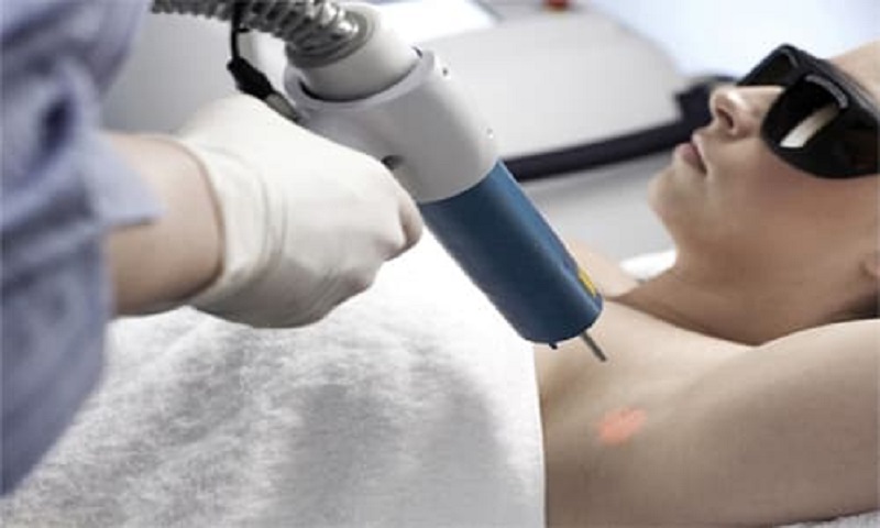 Trị hôi nách bằng laser cần thực hiện nhiều lần