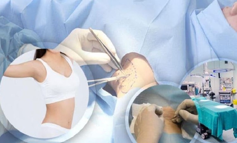 Cắt tuyến mồ hôi nách giúp loại bỏ triệt để