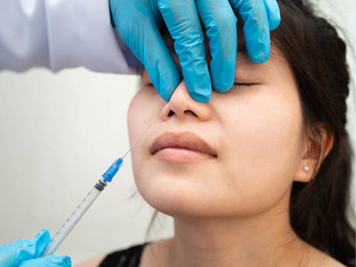 Tiêm filler mũi tạo độ cao tức thì, gần như không nghỉ dưỡng