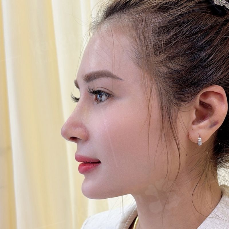 Mũi cần thời gian để ổn định, nên kiêng bia rượu
