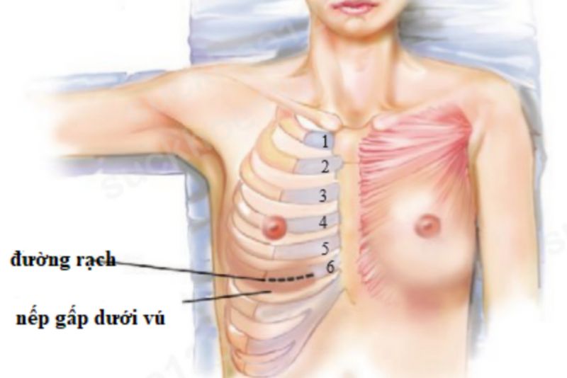 Mô phỏng vị trí lấy sụn sườn trên cơ thể