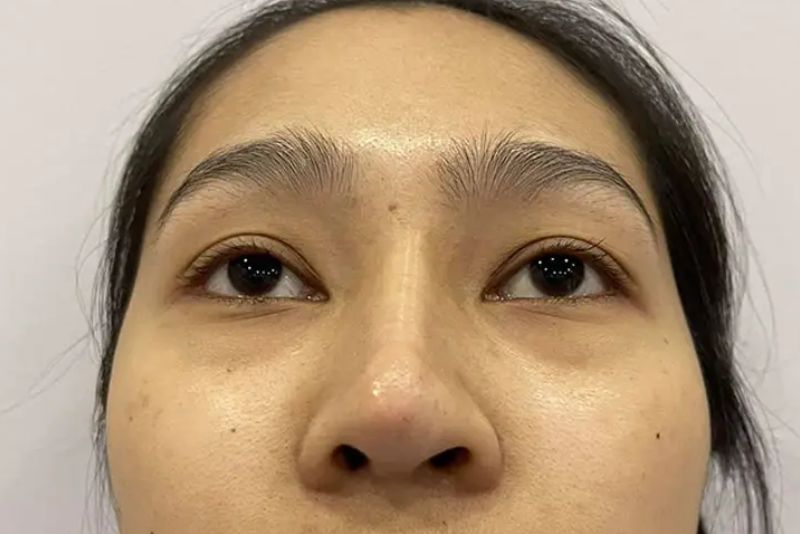 Sống mũi bị lệch khỏi trục giữa khuôn mặt gây mất cân đối rõ rệt