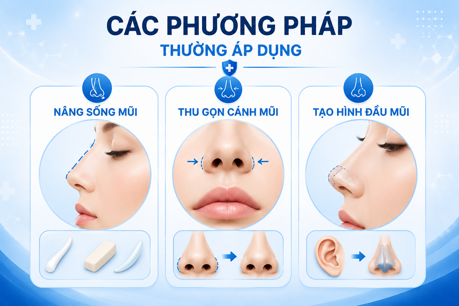 Các Phương Pháp Thường Áp Dụng để chỉnh sửa dáng mũi lân là nâng cao sống mũi, thu gọn cánh mũi, tạo hình đầu mũi