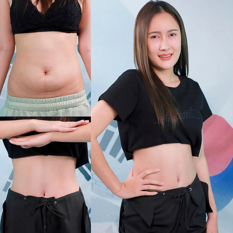 Khách hàng sở hữu vòng eo thon gọn, cân đối