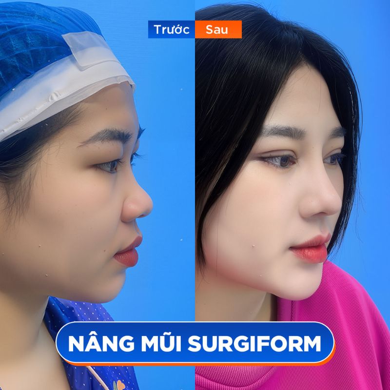 Dáng mũi cao tự nhiên sau 1 tháng nâng mũi 6D tại Kangnam