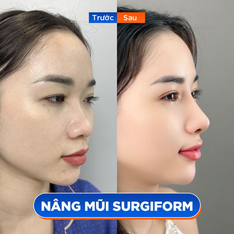 Dáng mũi sau nâng hài hòa với tổng thể gương mặt, nhìn tự nhiên ở mọi góc.