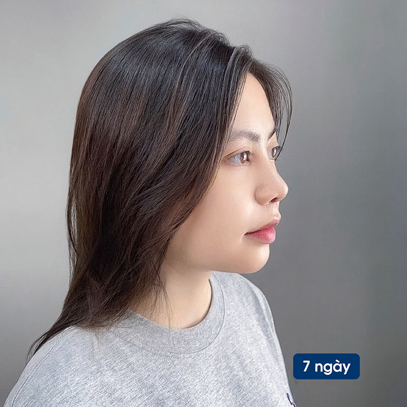 Dáng mũi thon, đầu mũi mềm mại giúp tổng thể gương mặt thanh thoát và trẻ trung hơn