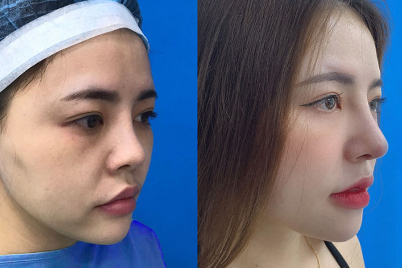 Khách hàng tự tin hơn sau khi sở hữu dáng mũi S Line đẹp tự nhiên