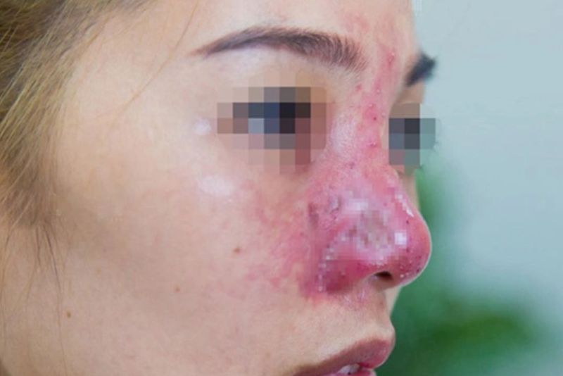 Đỏ đầu mũi sau nâng mũi không điều trị sẽ gây biến chứng