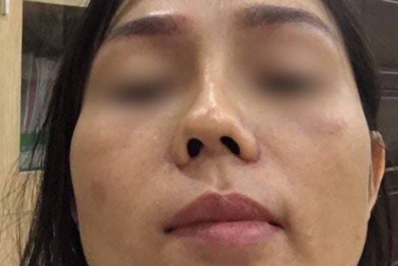Đặt sụn sai vị trí khiến mũi bị lệch