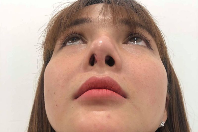 Các hoạt động mạnh vào mũi có thể gây lòi sụn