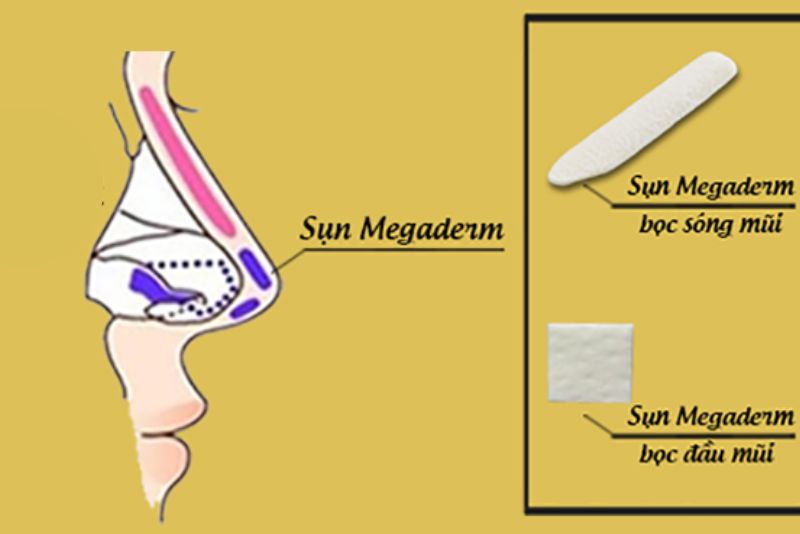 Nâng mũi bán cấu trúc bọc Megaderm dùng sun Megaderm bọc đầu mũi