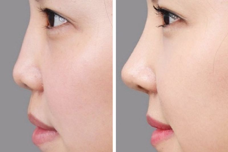 Dáng mũi cao thanh thoát chỉ sau 30 phút căng chỉ
