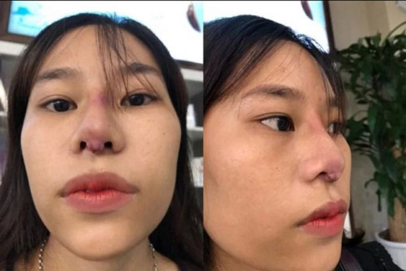 Biến dạng đầu mũi