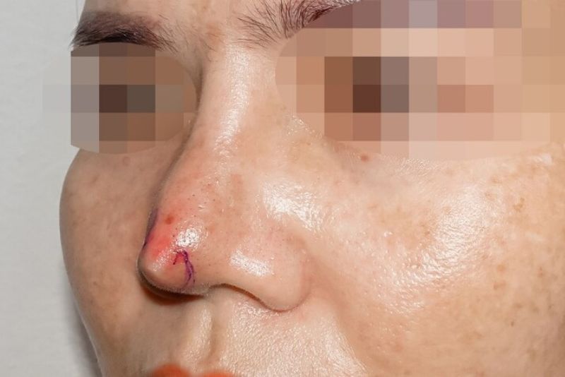 Mũi lệch, mất cân đối do thao tác phẫu thuật chưa chính xác
