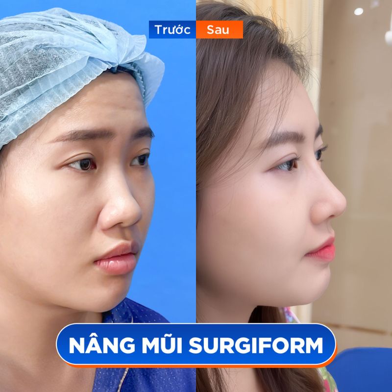 Khách hàng sở hữu sống mũi cao, đầu mũi thon gọn sau nâng mũi 6D
