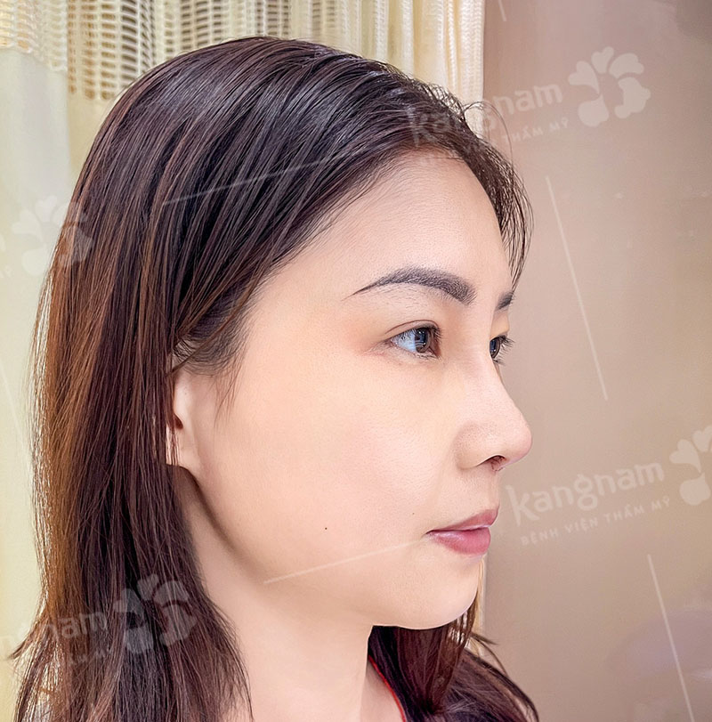Sụn tự thân giúp mũi ổn định lâu dài, hạn chế biến chứng.
