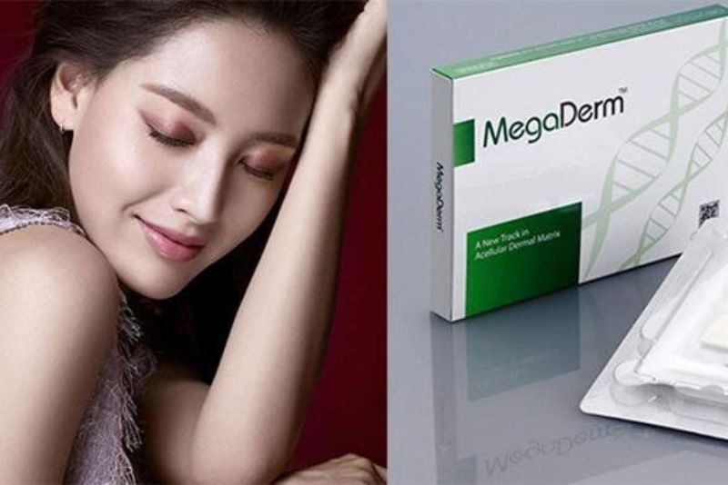 Nâng mũi Megaderm là phương pháp sử dụng sụn Megaderm nâng mũi