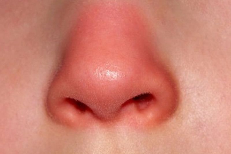Mũi sưng đỏ sau uống bia rượu cần tái khám ngay