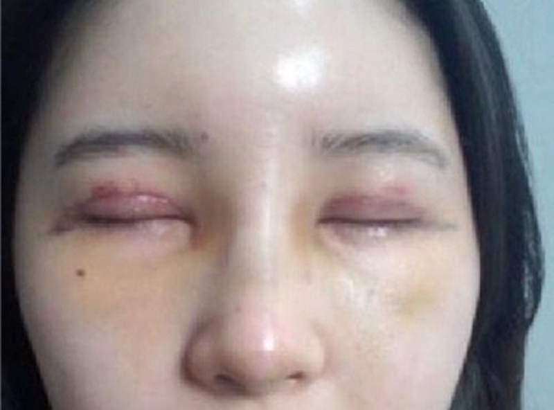 Sưng tấy, nhiễm trùng mí mắt
