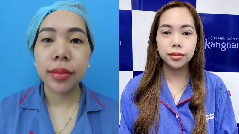 Nhấn mí giúp đôi mắt tươi trẻ, tự nhiên
