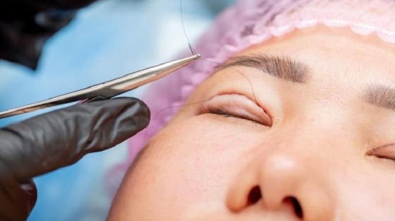 Sợi chỉ collagen được sử dụng trong nhấn mí vi sợi