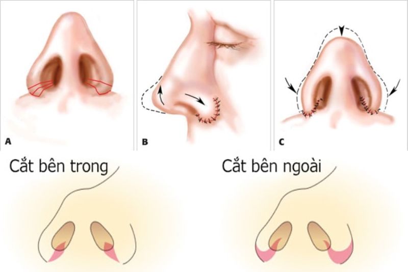 Cắt cánh mũi rạch một đường nhỏ ở tại vị trí tiếp giáp giữa mũi, má hoặc trong khoang mũi