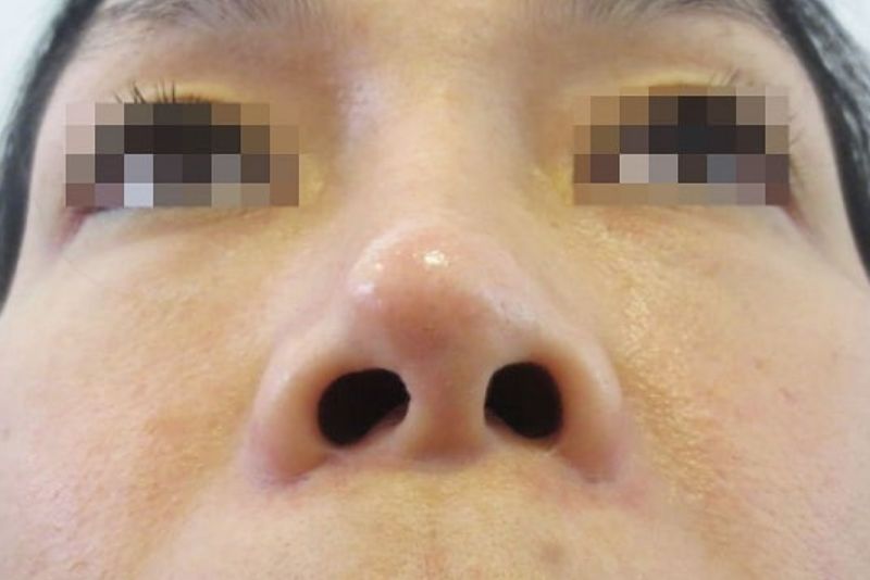 Lộ sụn đầu mũi – biến chứng nghiêm trọng cần can thiệp ngay